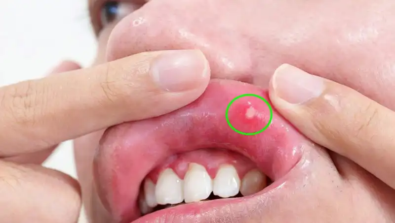 Kanserin Sessiz Belirtileri: Dilin Alınması Gereken Korkutucu Durum