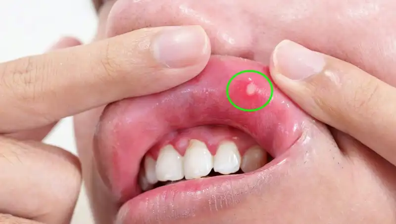 Vücudunuzdaki B Vitamini Eksikliği: Bu 5 Belirtisi Dikkatinizi Çekmeli!
