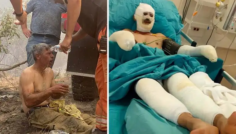 Yanıyorum Diye Feryat Eden Orman İşçisine Hızla Müdahale Edildi